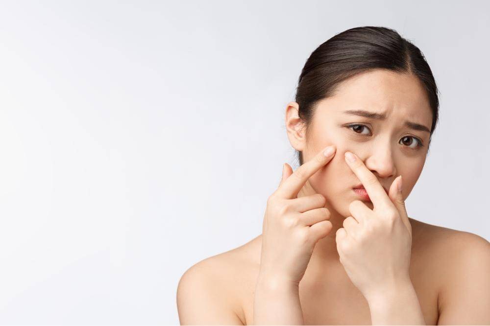 7 Best Local Acne Spot Treatments to Effectively Tackle Stubborn Breakouts