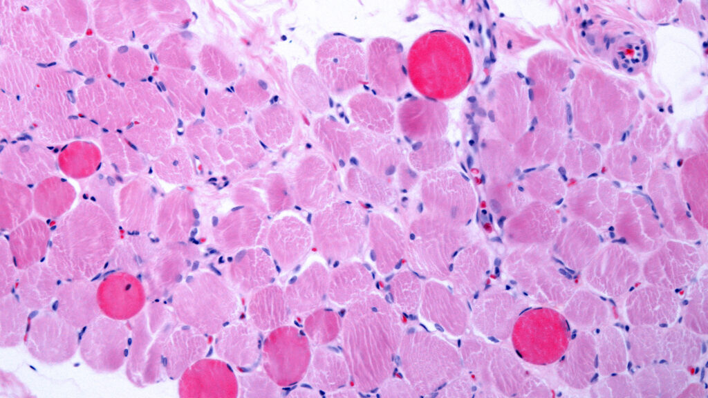 Capricor Cell Therapy Enhances Heart Function in Duchenne Muscular Dystrophy Patients: STAT