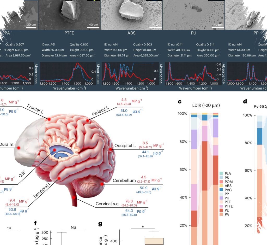 Scientists Find Plastic Particles In Nearly Every Brain Sample, With Distinct Spread Patterns