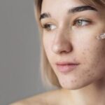 5 Acne Serums Dermatologists Often Recommend, The Fastest Way To Fade Stubborn Acne Marks