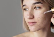 5 Acne Serums Dermatologists Often Recommend, The Fastest Way To Fade Stubborn Acne Marks