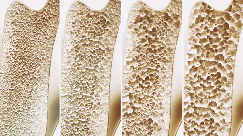 Calcium and Vitamin D May Not Prevent Falls or Fractures, Major Review Finds