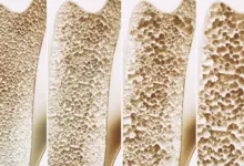 Calcium and Vitamin D May Not Prevent Falls or Fractures, Major Review Finds