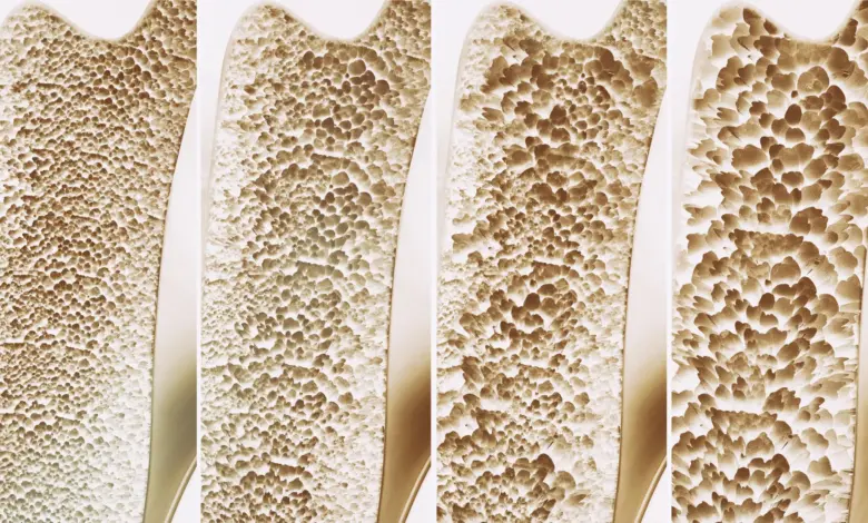 Calcium and Vitamin D May Not Prevent Falls or Fractures, Major Review Finds