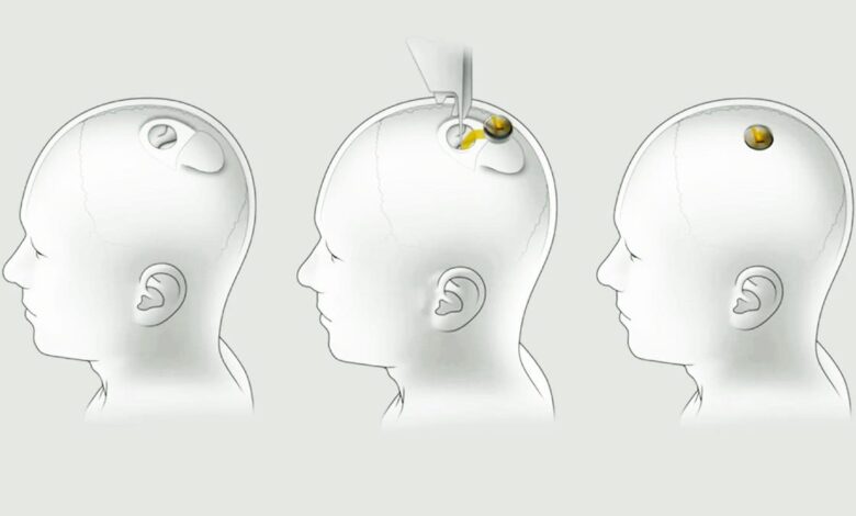 Samsung Moves Into Neuralink’s Brain Chip Race, A New Front Opens for Musk’s Ecosystem